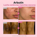 Arbutin. ¡Adiós manchas y acné!